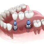 dental-bridges